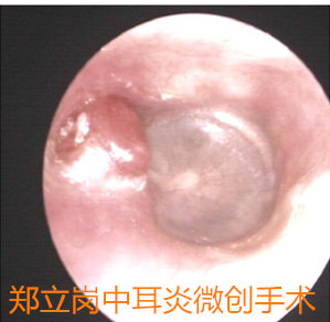 听力下降耳鸣一定是神经瘤吗,耳道胆脂瘤会引起中耳炎吗