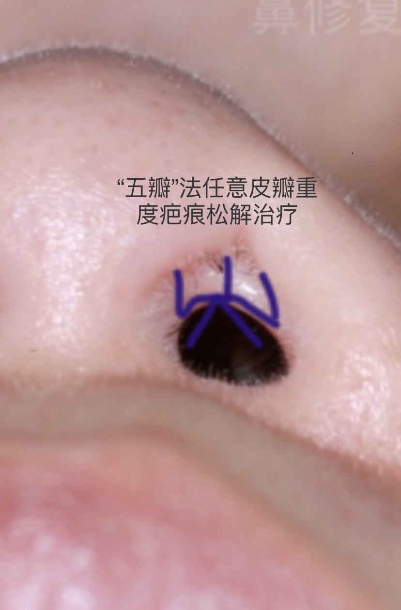 高难度扁鼻子修复,鼻综合手术疤痕修复