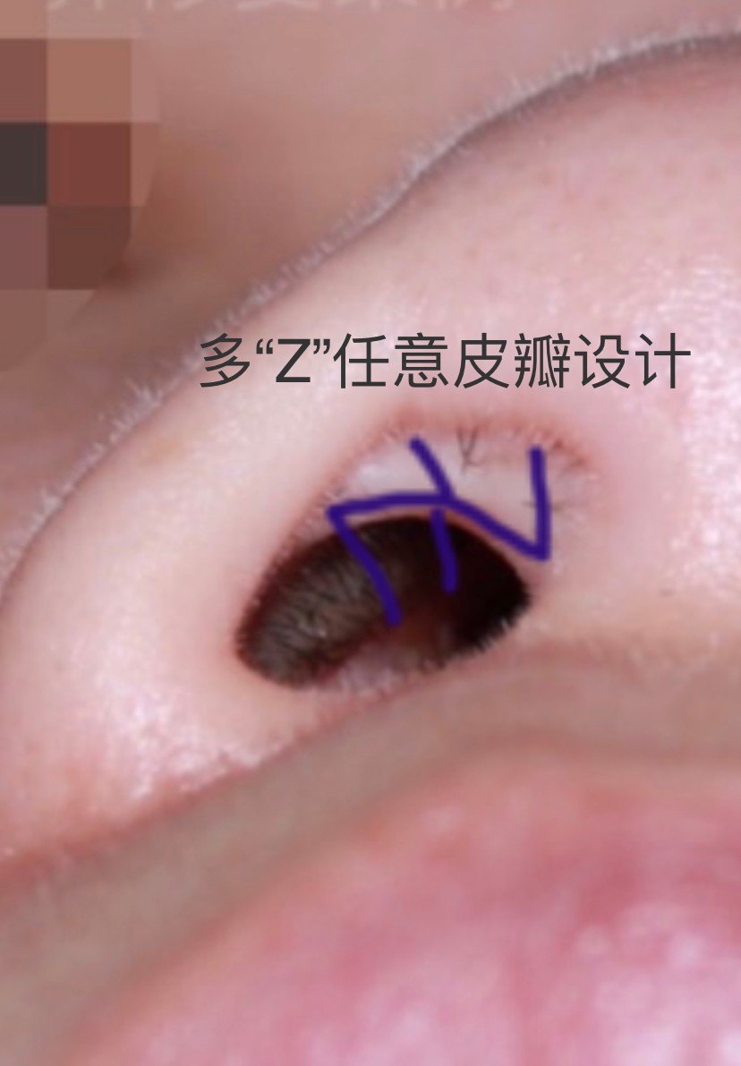 高难度扁鼻子修复,鼻综合手术疤痕修复