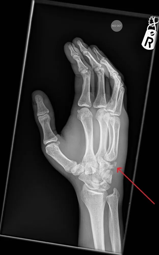 右手桡骨疼痛,右手钩状骨骨折20天