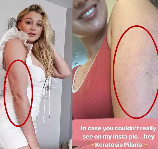 别放弃,烦人的“鸡皮疙瘩”,真的还可以再救一下