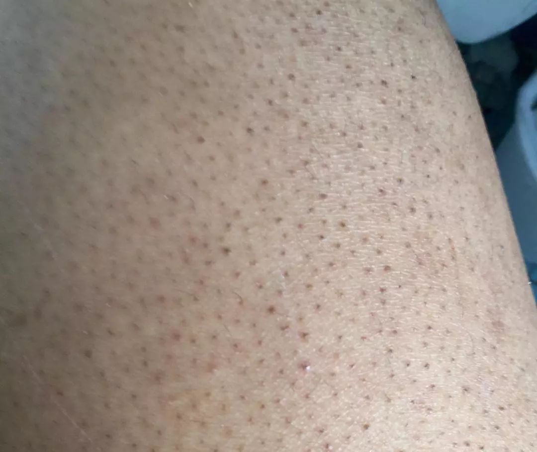 别放弃,烦人的“鸡皮疙瘩”,真的还可以再救一下