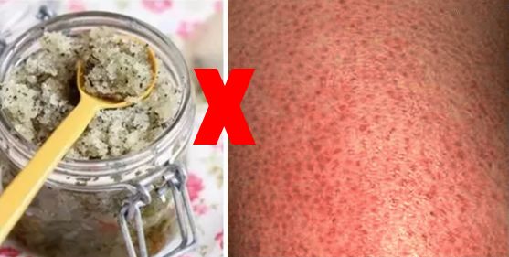 别放弃,烦人的“鸡皮疙瘩”,真的还可以再救一下