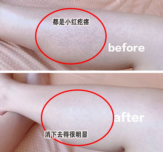 别放弃,烦人的“鸡皮疙瘩”,真的还可以再救一下