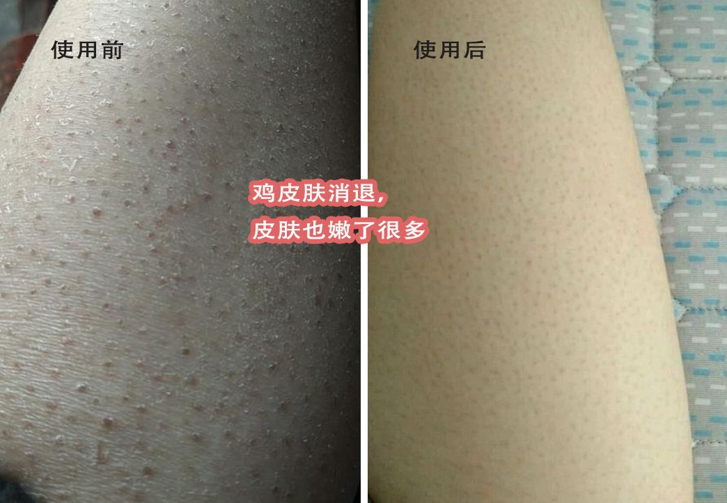 别放弃,烦人的“鸡皮疙瘩”,真的还可以再救一下