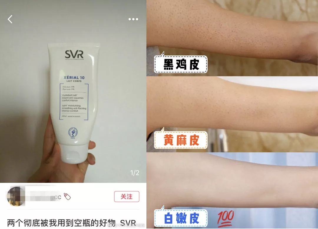 别放弃,烦人的“鸡皮疙瘩”,真的还可以再救一下