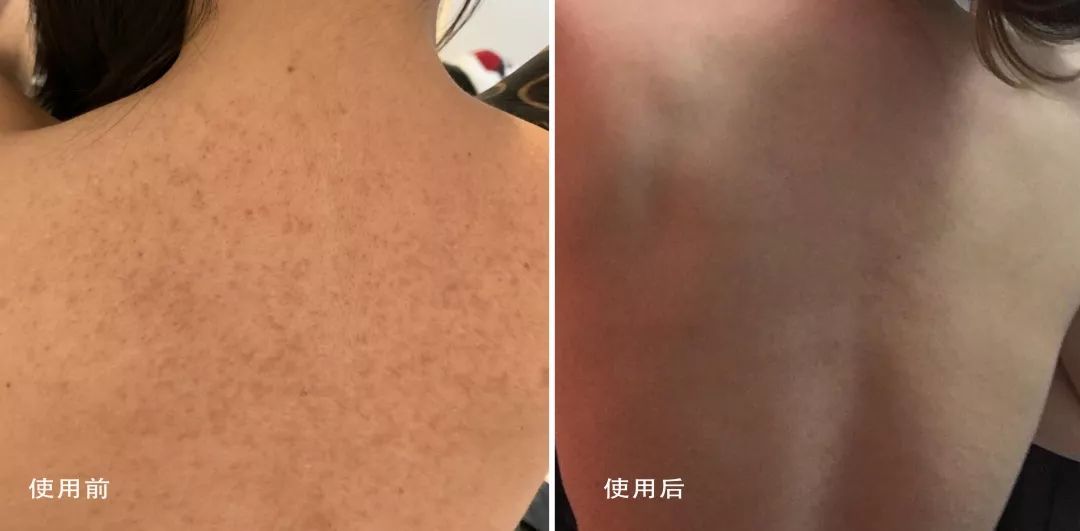 别放弃,烦人的“鸡皮疙瘩”,真的还可以再救一下