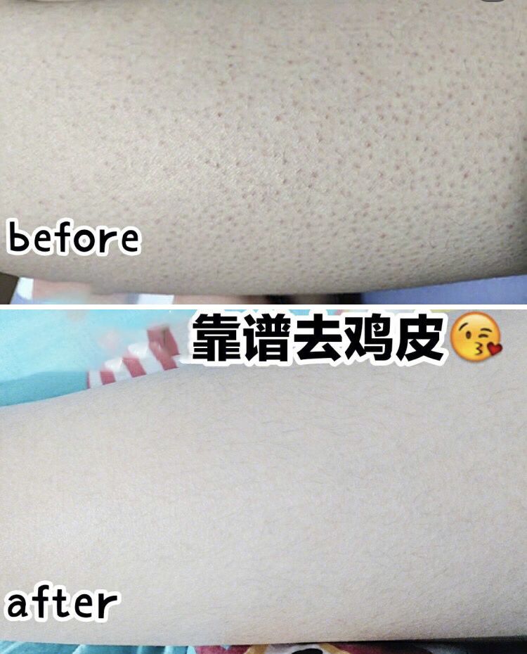 别放弃，烦人的“鸡皮疙瘩”，真的还可以再救一下