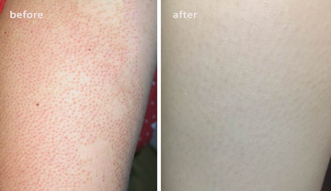 别放弃,烦人的“鸡皮疙瘩”,真的还可以再救一下