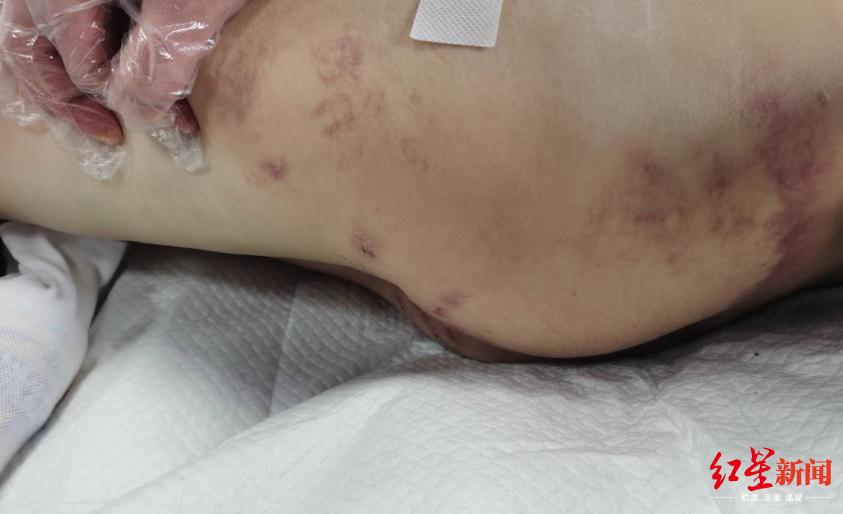 山西女童被继母虐打成植物人,山西女童遭继母虐待案结果