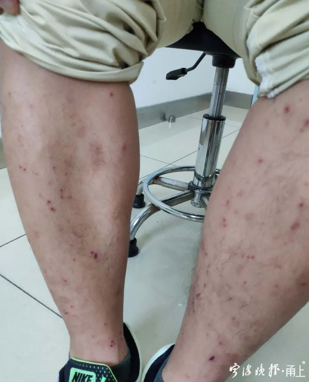 一夜之间身上起了好多小红点,30岁女性身上发现很多小红点