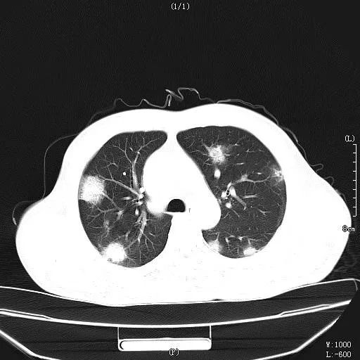 抗病毒治疗慢乙肝机制,慢性乙肝抗病毒治疗标准