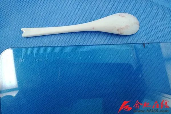 女子误吞17厘米长勺原因,18岁女子误吞17厘米长勺