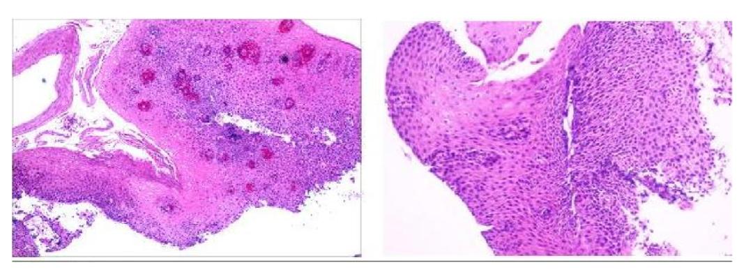 食管癌樊青霞,樊青霞讲食道癌