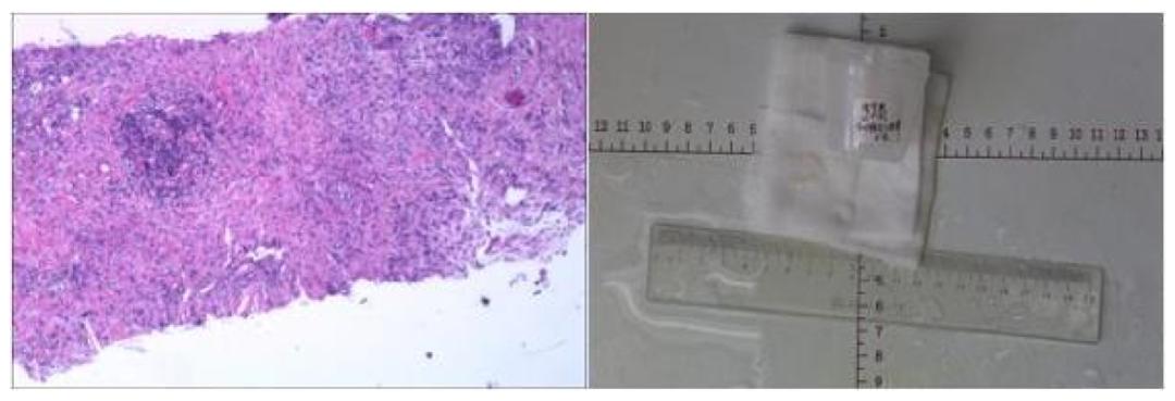 食管癌樊青霞,樊青霞讲食道癌