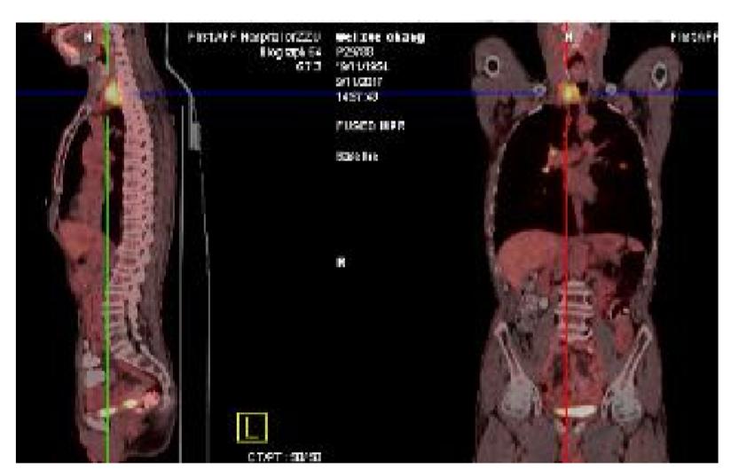 食管癌樊青霞,樊青霞讲食道癌