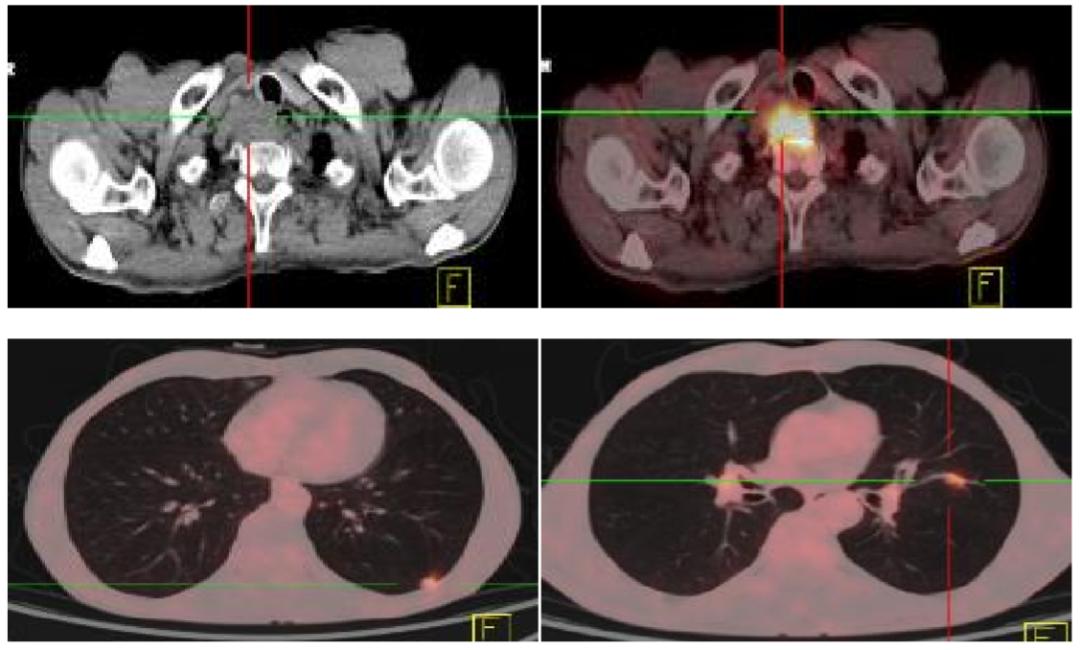 食管癌樊青霞,樊青霞讲食道癌