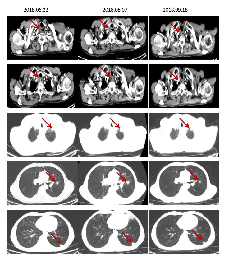 食管癌樊青霞,樊青霞讲食道癌