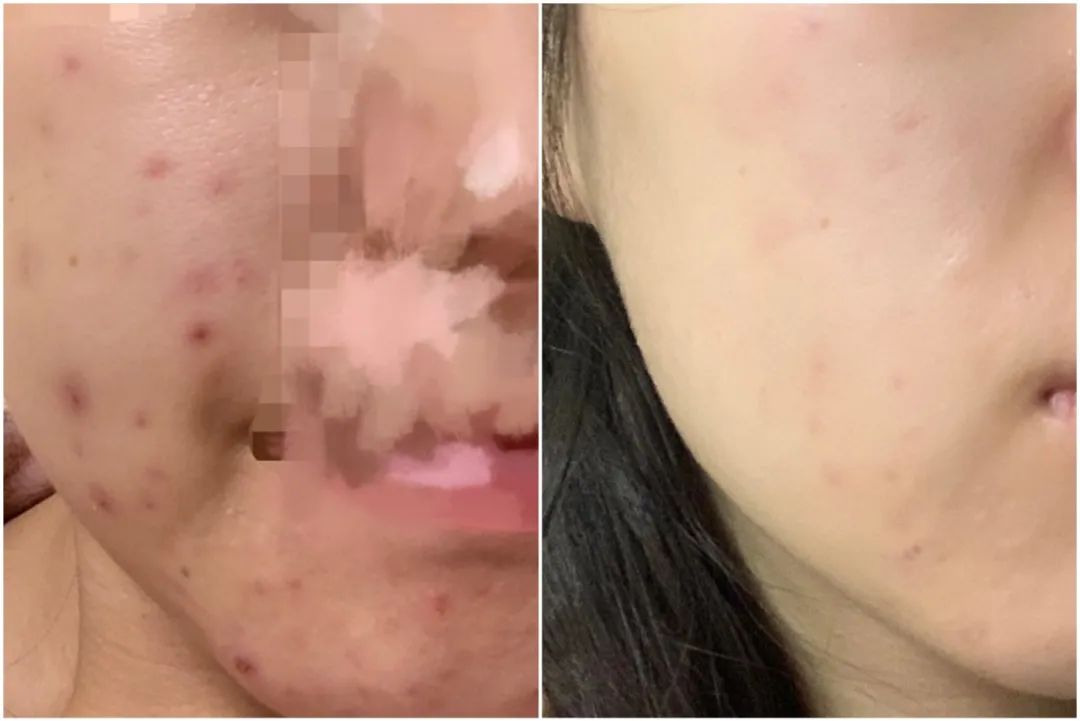 做完医美用可复美吗,你知道做完医美有多可怕