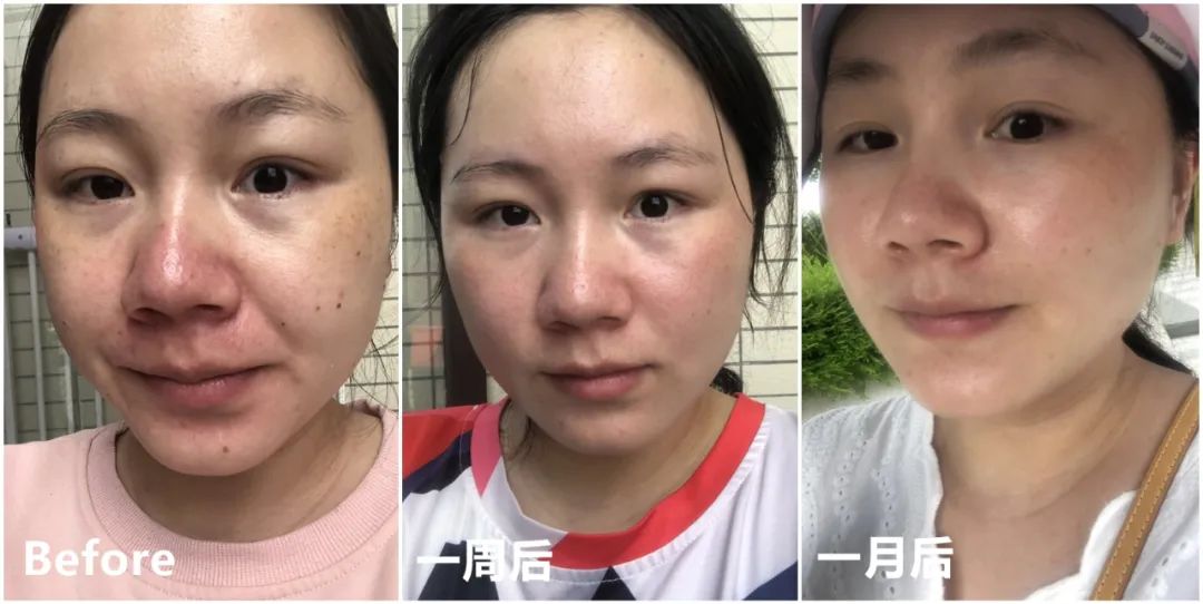 做完医美用可复美吗,你知道做完医美有多可怕