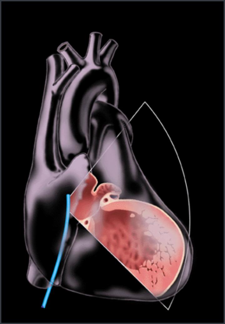 河北房颤射频消融术的费用,唐山工人医院新院区