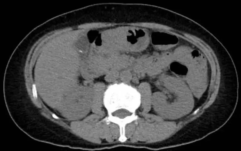 皮肤红疹有小水泡病例,病理性黄疸出现皮疹