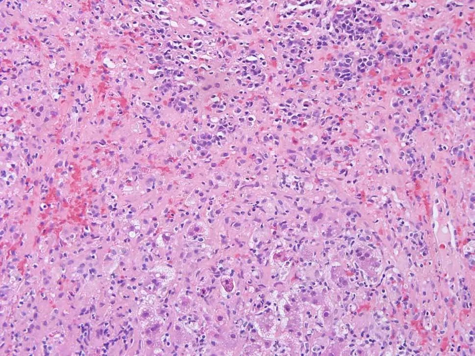 皮肤红疹有小水泡病例,病理性黄疸出现皮疹