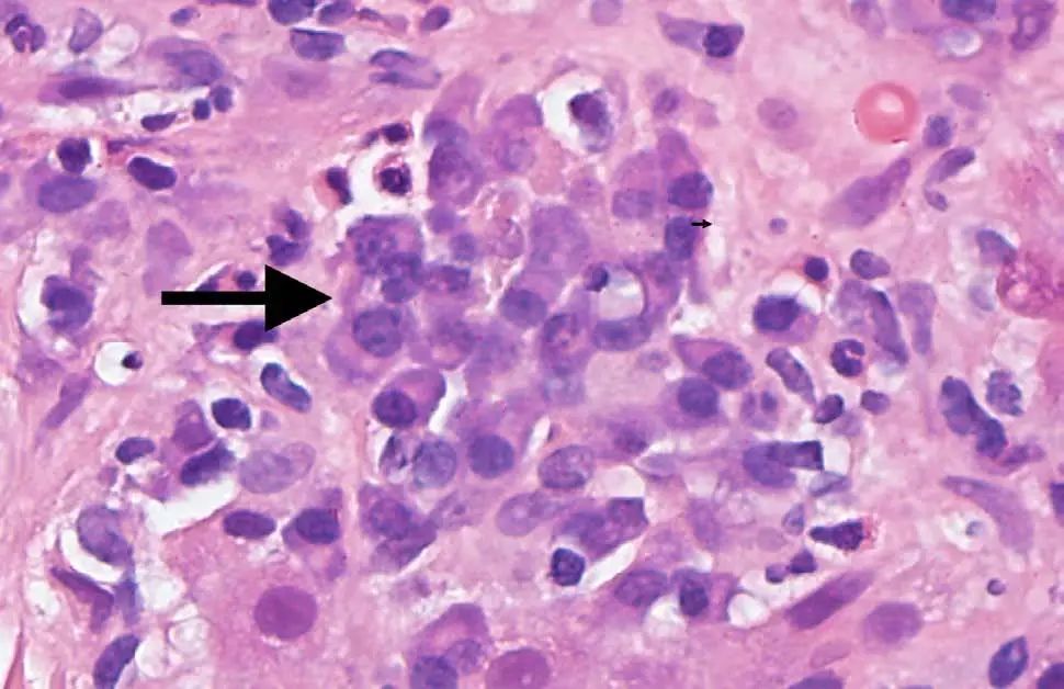 皮肤红疹有小水泡病例,病理性黄疸出现皮疹