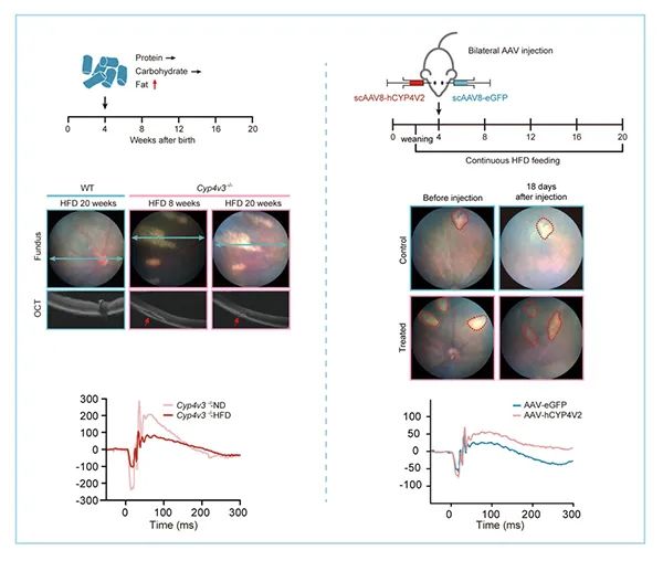 基因治疗视网膜色素变性临床应用,结晶样视网膜色素变性遗传概率