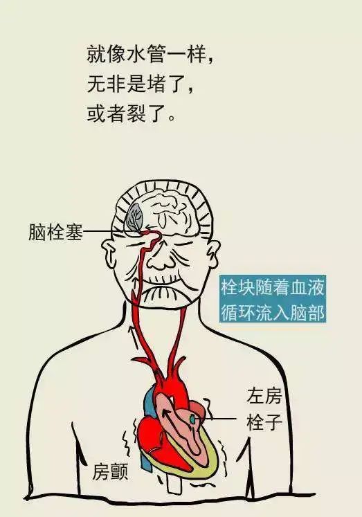 脑卒中中医康复治疗方案,脑卒中患者医院如何处理