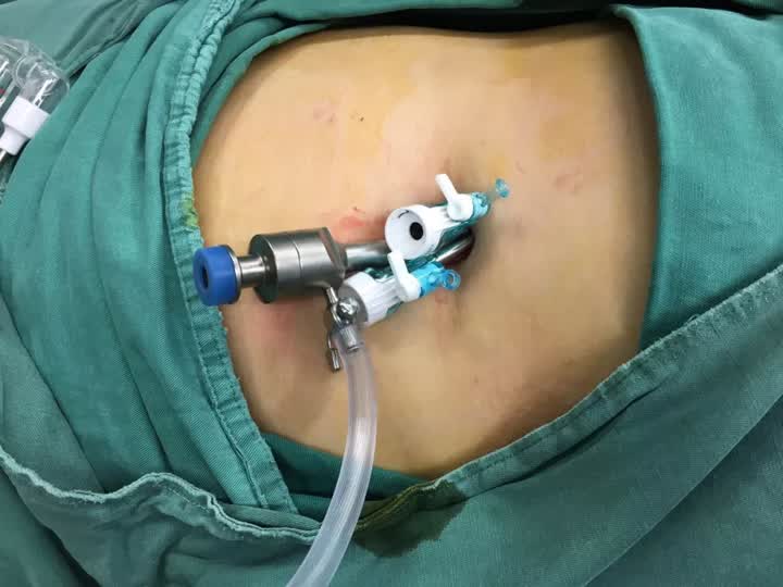 单孔腹腔镜术后一个半月伤口不好,单孔腹腔镜无疤痕