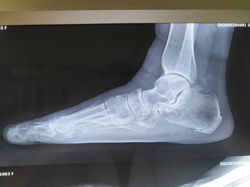 手足外科微创手术,巴彦淖尔市医院手足显微外科