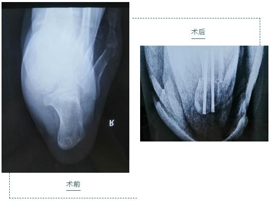 手足外科微创手术,巴彦淖尔市医院手足显微外科