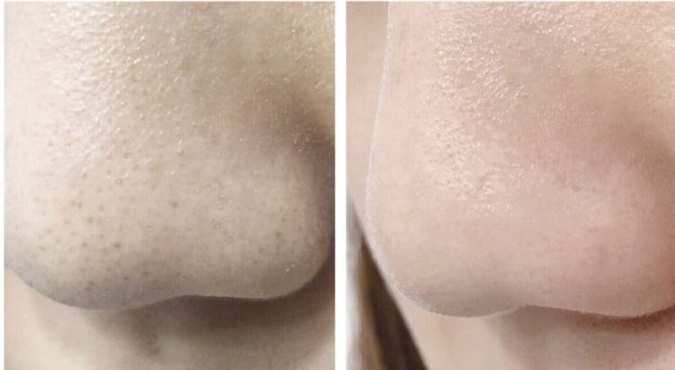 用手搓脸搓出泥把脸搓掉皮,用它搓一搓皮肤嫩滑透亮不显老