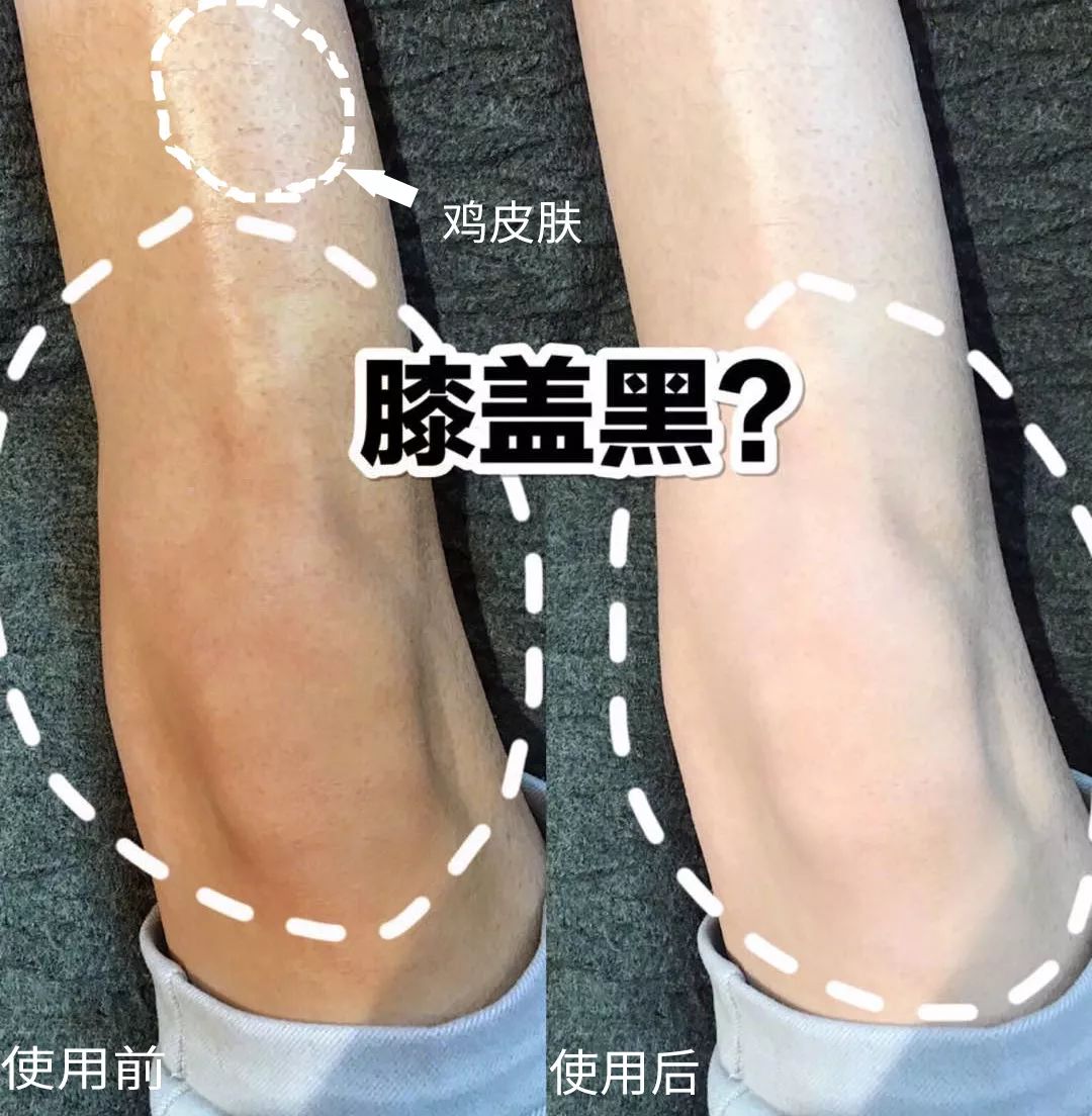 为什么夏天不露腿了,夏天不露腿热吗