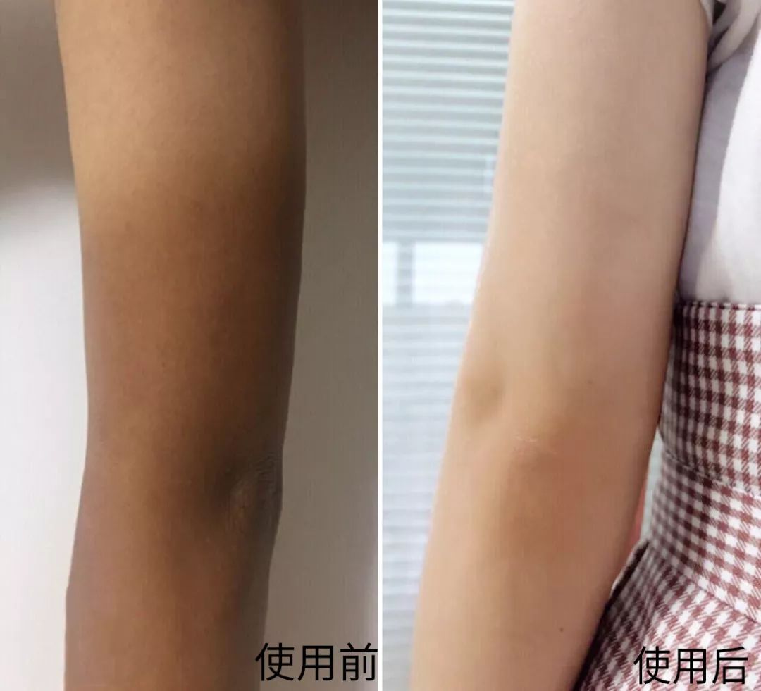 为什么夏天不露腿了,夏天不露腿热吗