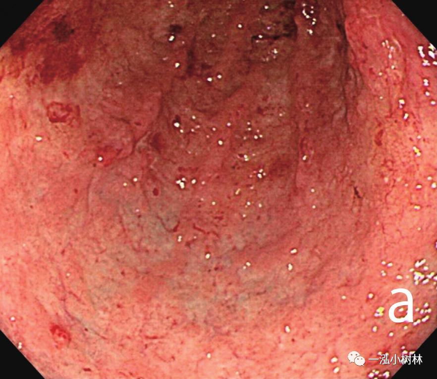 胃高级上皮内瘤变内镜案例,胃局灶性淀粉样变性预后
