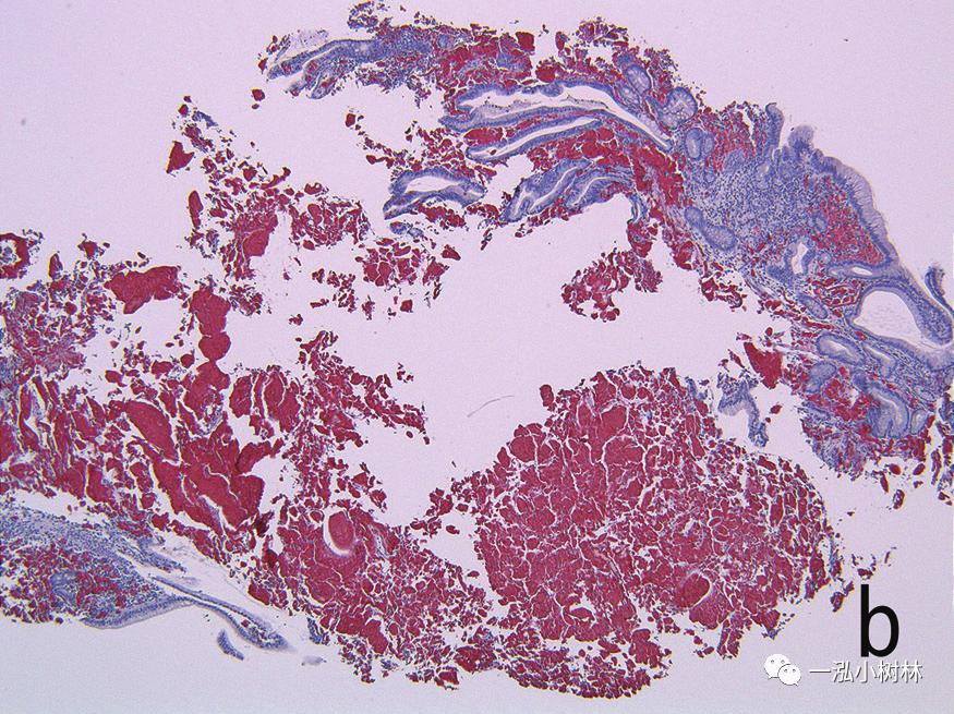 胃高级上皮内瘤变内镜案例,胃局灶性淀粉样变性预后