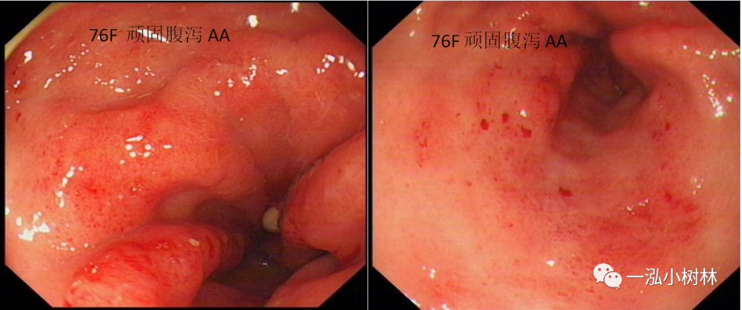 胃高级上皮内瘤变内镜案例,胃局灶性淀粉样变性预后