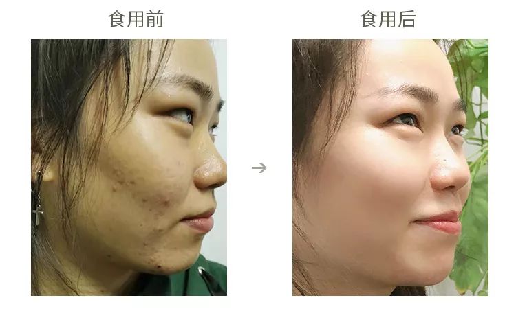 口臭痘痘胃脘疼便秘,痘痘多口臭怎么办