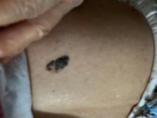 注意|这几天上万网友在身上找痣！知名医生：长在这些地方的特别留意！