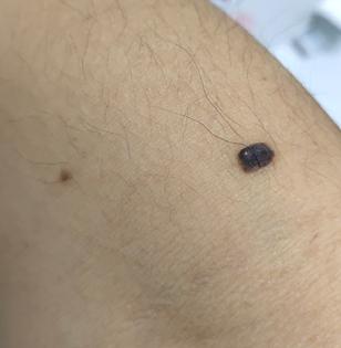 注意|这几天上万网友在身上找痣！知名医生：长在这些地方的特别留意！