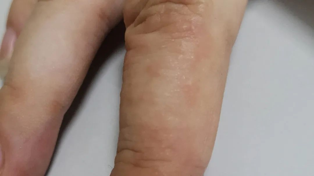 千万别挠！最近好多人都长了这种“痒痒的小水泡”！医生提醒，应该这样对付它……