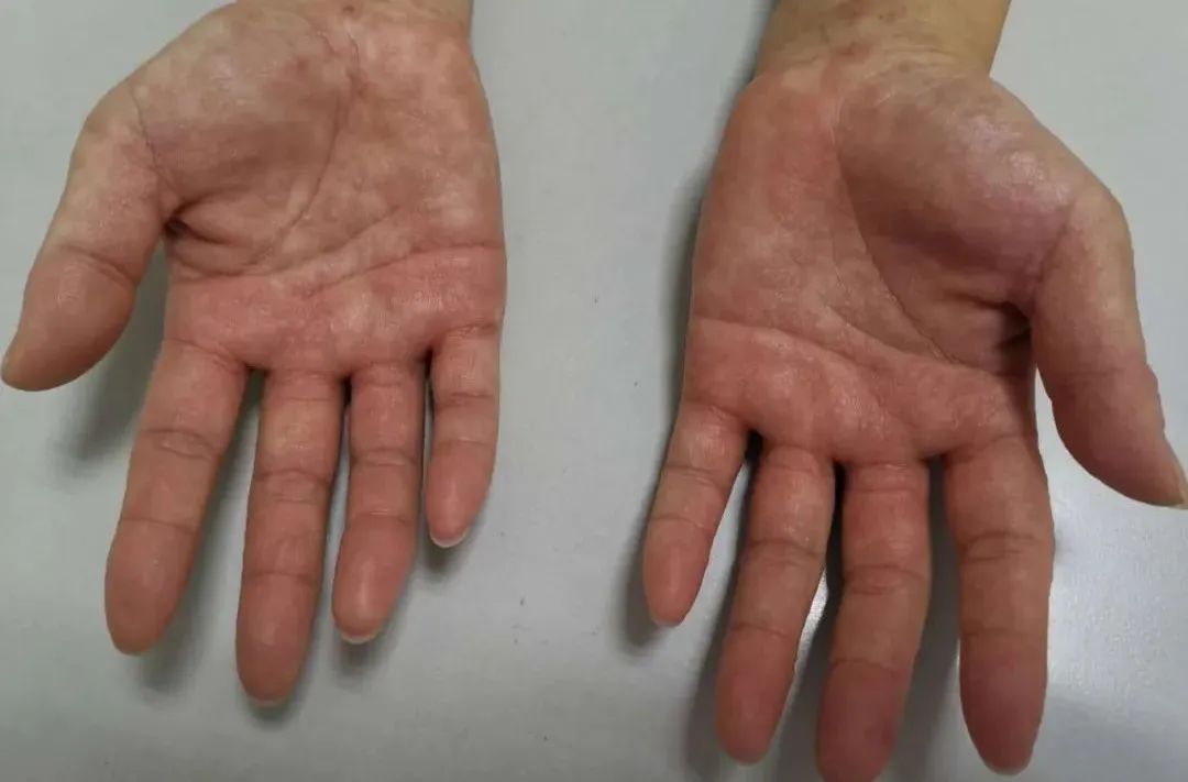 千万别挠！最近好多人都长了这种“痒痒的小水泡”！医生提醒，应该这样对付它……