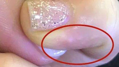 千万别挠！最近好多人都长了这种“痒痒的小水泡”！医生提醒，应该这样对付它……