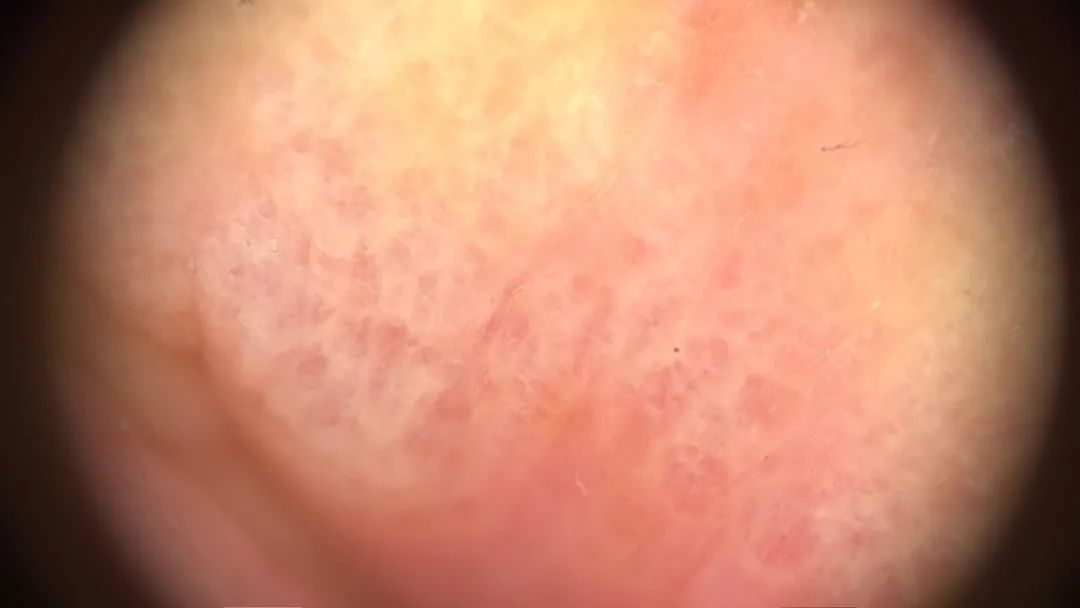 千万别挠！最近好多人都长了这种“痒痒的小水泡”！医生提醒，应该这样对付它……