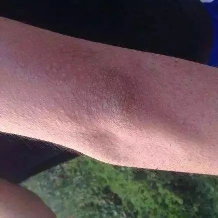 麻疹防控温馨提示,春季麻疹预防小知识图片