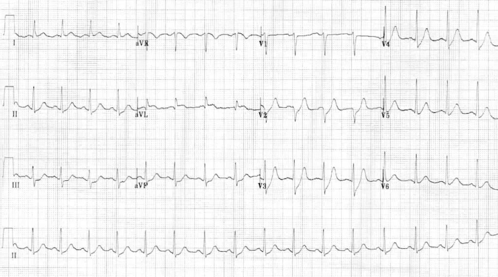 心肌缺血的心电图图解,心肌缺血的典型心电图图片