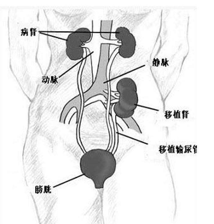 有关肾移植的知识,肾移植术后服药科普