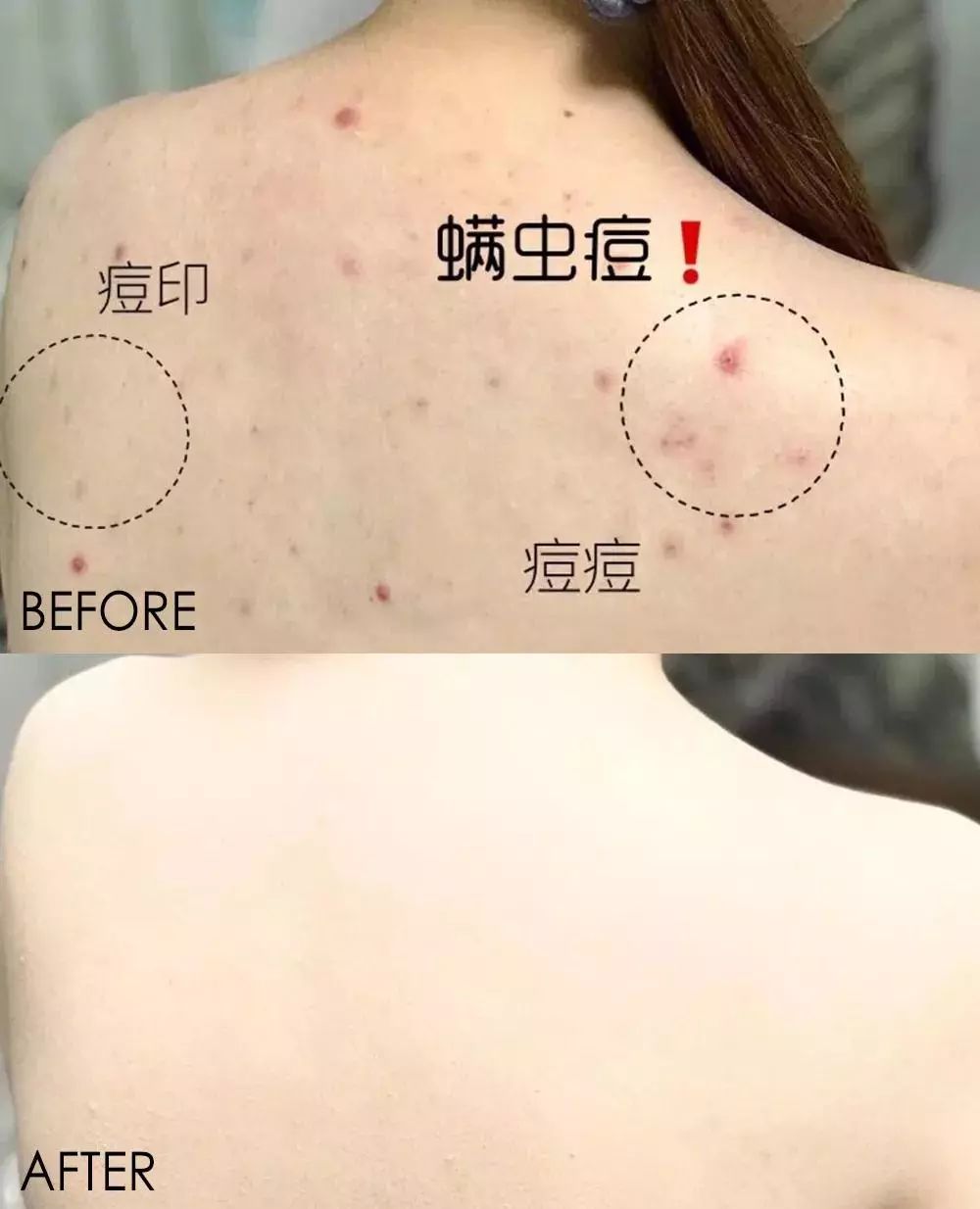 鼻头痘痘挤出来的白色物质是什么,团状红痘痘